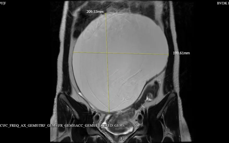 B&oacute;c u buồng trứng khổng lồ 20cm cho&aacute;n to&agrave;n ổ bụng- Ảnh 1.