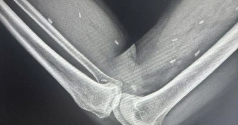 Ph&aacute;t hiện nhiều k&eacute;n s&aacute;n ở ch&acirc;n người đ&agrave;n &ocirc;ng Quảng Trị do th&oacute;i quen ăn rau sống- Ảnh 1.