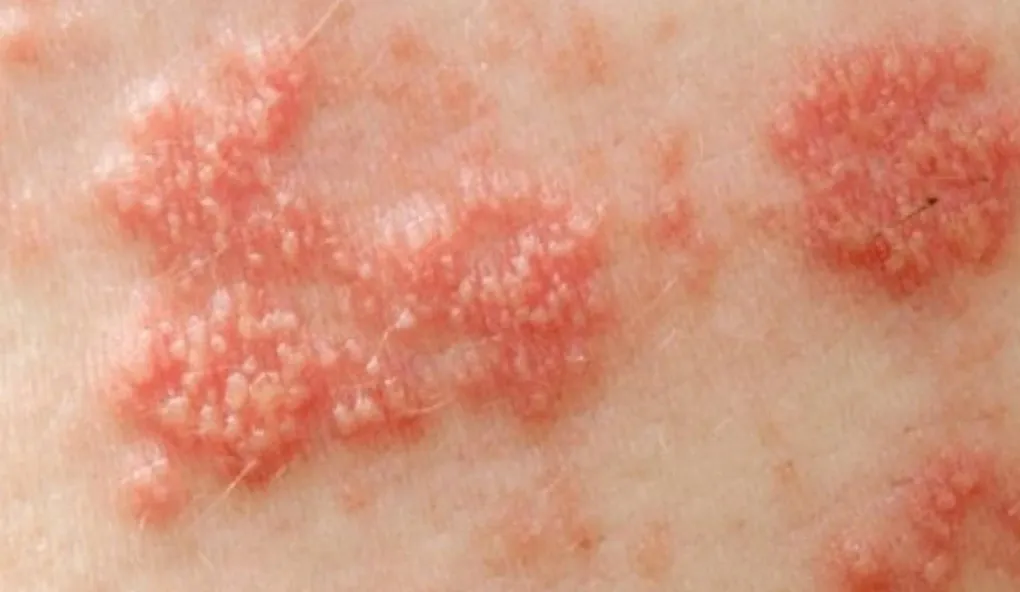 Đau sau zona thần kinh &ndash; cơn &aacute;m ảnh k&eacute;o d&agrave;i, th&aacute;ch thức lớn của y học hiện đại- Ảnh 1.