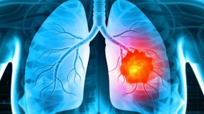 5 dấu hiệu ung thư phổi c&oacute; thể ph&aacute;t hiện sớm, tuyệt đối kh&ocirc;ng n&ecirc;n bỏ qua- Ảnh 1.