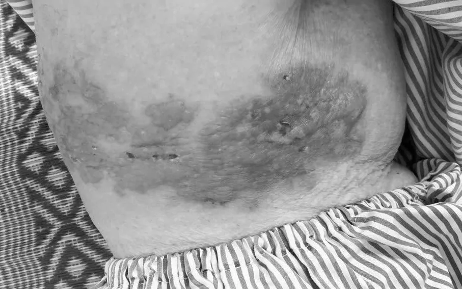 Đắp thuốc nam chữa zona thần kinh: Nguy cơ nhiễm tr&ugrave;ng da nặng- Ảnh 1.