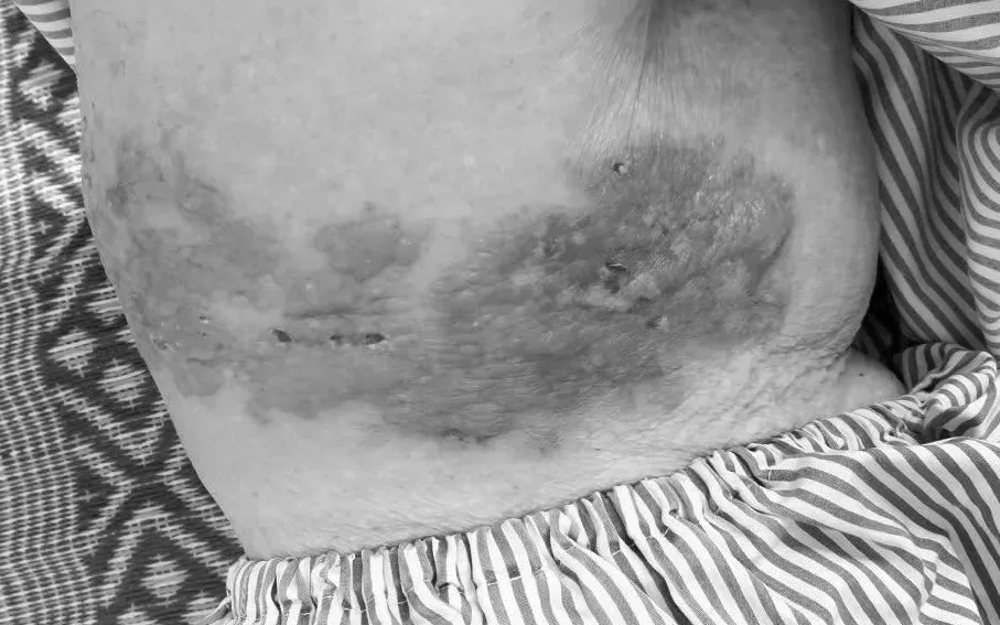 Tự &yacute; đắp thuốc nam chữa zona, nhiều bệnh nh&acirc;n nhập viện v&igrave; vi&ecirc;m da nặng- Ảnh 1.