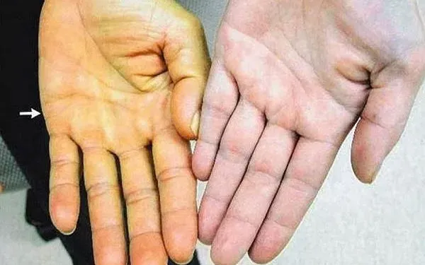 C&ocirc; g&aacute;i 29 tuổi suy gan cấp sau khi tự d&ugrave;ng thuốc nam chữa đau dạ d&agrave;y- Ảnh 1.