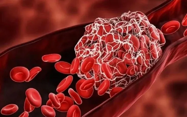 Những dấu hiệu &acirc;m thầm cảnh b&aacute;o nguy cơ h&igrave;nh th&agrave;nh cục m&aacute;u đ&ocirc;ng- Ảnh 1.