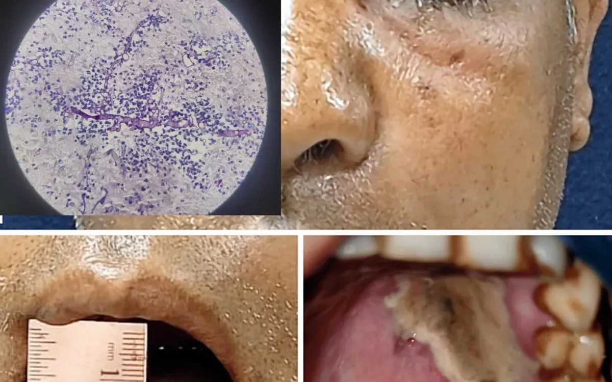 Ph&aacute;t hiện ca nấm đen x&acirc;m lấn n&atilde;o tại Ph&uacute; Thọ, nguy cơ tử vong cao nếu chậm trễ- Ảnh 1.