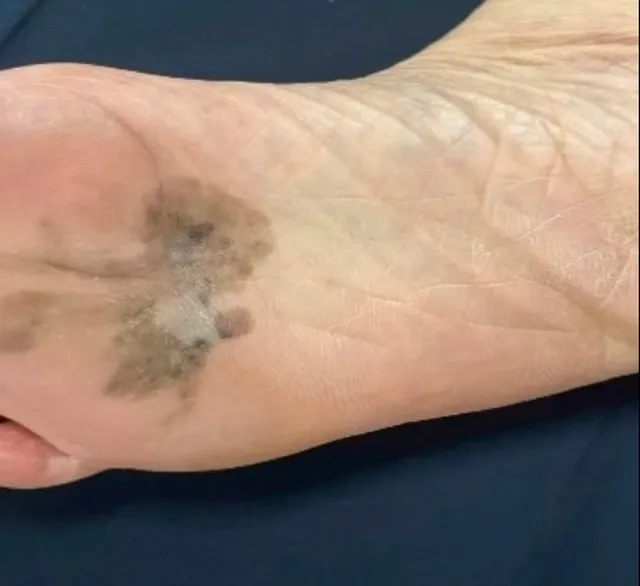 Ung thư hắc tố ở b&agrave;n tay, b&agrave;n ch&acirc;n dễ bị bỏ s&oacute;t do vị tr&iacute; kh&oacute; nhận biết- Ảnh 1.