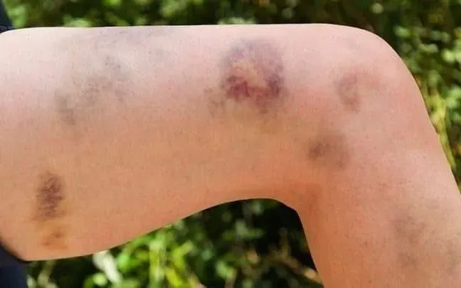 Phụ nữ nguy kịch v&igrave; d&ugrave;ng thuốc nam kh&ocirc;ng r&otilde; nguồn gốc, mắc bệnh hiếm TTP- Ảnh 1.