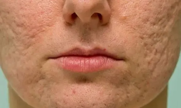 Sẹo rỗ c&oacute; tự đầy l&ecirc;n theo thời gian? Chuy&ecirc;n gia giải đ&aacute;p v&agrave; c&aacute;ch cải thiện hiệu quả- Ảnh 1.