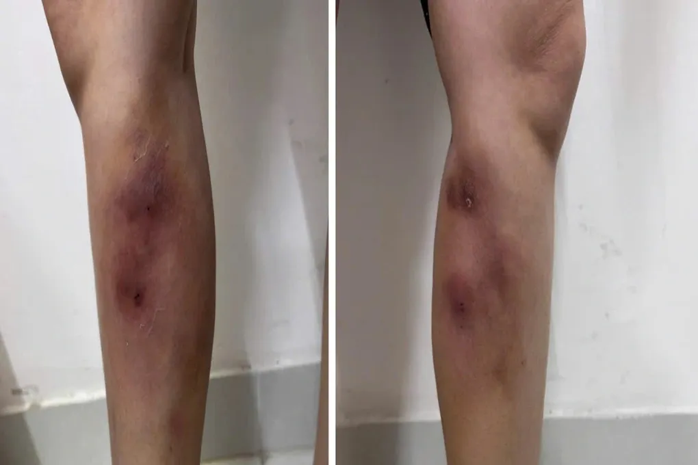 C&ocirc; g&aacute;i 29 tuổi biến dạng hai ch&acirc;n sau khi ti&ecirc;m filler &ldquo;nắn thẳng ch&acirc;n&rdquo; tại nh&agrave;- Ảnh 1.