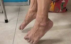 Hình ảnh người bệnh bị teo cơ chày trước và yếu 2 chân khi vào viện, bàn chân rủ xuống không gấp bàn chân về phía mu được.