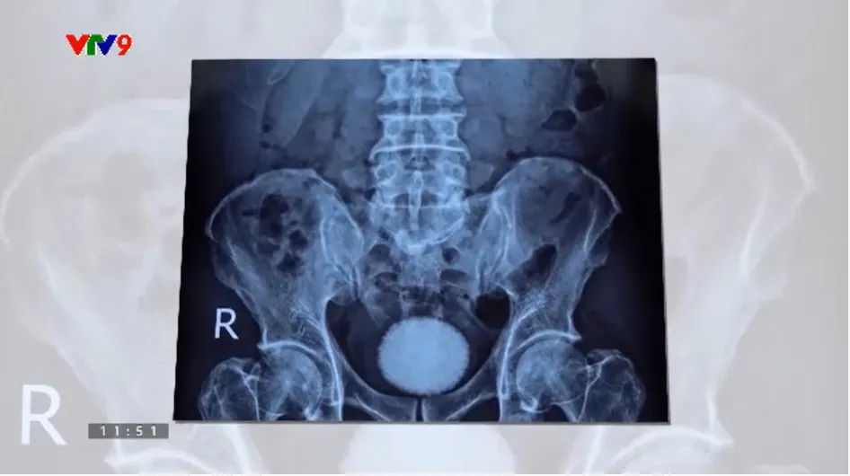 Alo Doctor (16/3/2026): Phẫu thuật lấy viên sỏi bàng quang "khủng" bằng quả trứng ngỗng