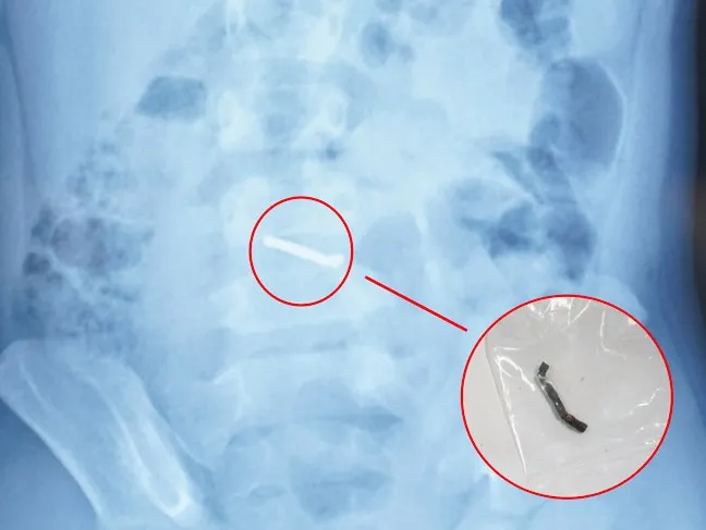 Ph&aacute;t hiện nhiều vi&ecirc;n nam ch&acirc;m nhỏ trong ruột b&eacute; trai 5 tuổi- Ảnh 1.