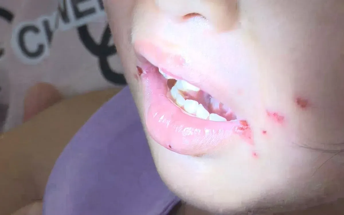 Ca tay ch&acirc;n miệng tăng gần gấp đ&ocirc;i tại TP.HCM, sốt xuất huyết giảm- Ảnh 1.