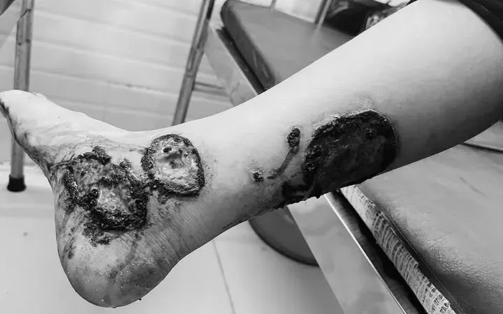 Tự &yacute; đắp thuốc nam, bệnh nh&acirc;n bỏng nặng v&ugrave;ng ch&acirc;n- Ảnh 1.