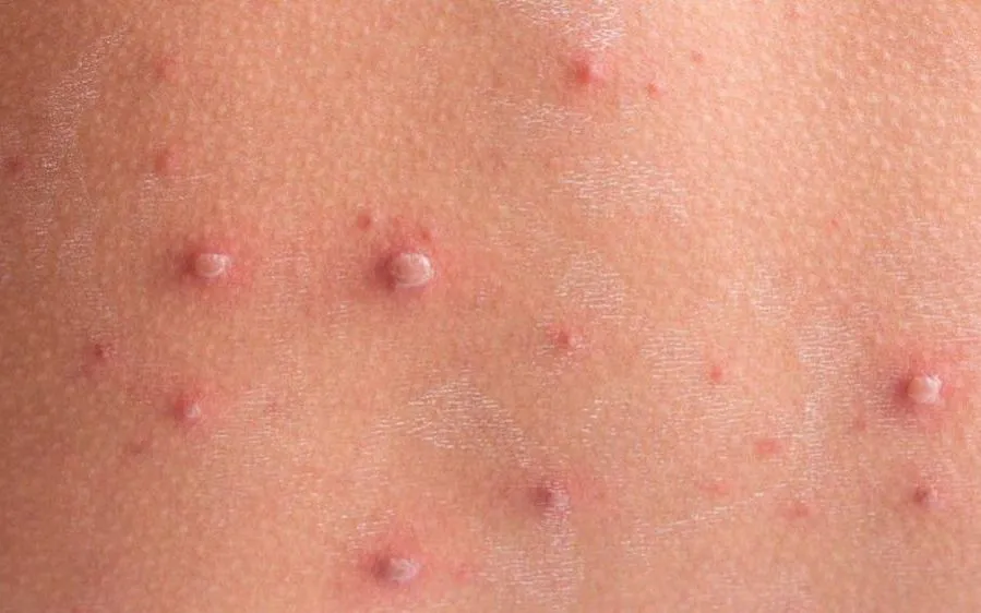 Các mụn nước trên da của người mắc bệnh thủy đậu. Ảnh: HCDC
