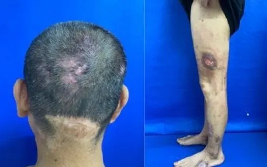 Viêm Da Tự Tạo: Thách Thức Trong Chẩn Đoán Và Điều Trị