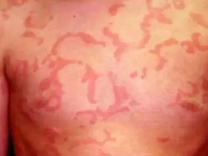 Lạm dụng corticoid trị m&agrave;y đay mạn t&iacute;nh: Nguy cơ biến chứng nặng, ảnh hưởng thị lực- Ảnh 1.