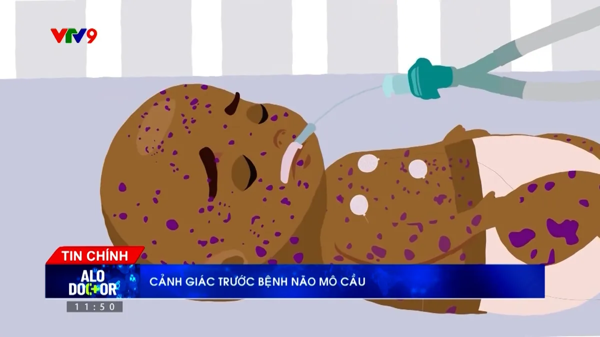 Alo Doctor (26/3/2026): Cảnh giác bệnh não mô cầu gây chết người