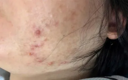 Thai phụ mắc thủy đậu: Nguy cơ cao, cần chủ động phòng ngừa