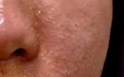 Viêm Da Dị Ứng Do Mỹ Phẩm: Cảnh Báo Từ Bệnh Viện 19-8