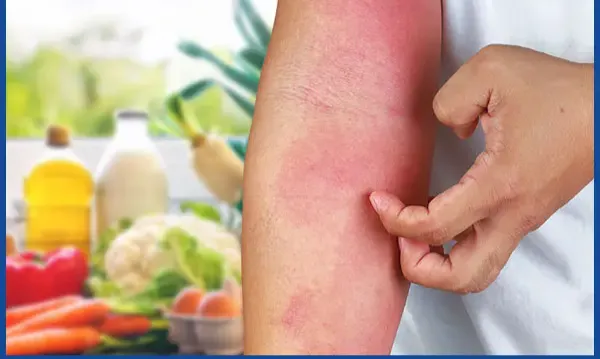 Cảnh gi&aacute;c với dị ứng thực phẩm: Nguy cơ kh&ocirc;ng thể xem nhẹ- Ảnh 1.