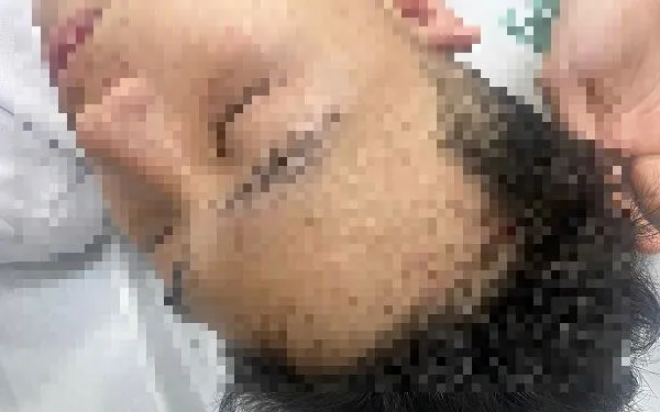 Nam sinh N.Q.M. đang điều trị tại bệnh viện