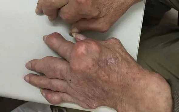 Gout: Nguy cơ biến dạng khớp và tàn phế nếu không điều trị đúng