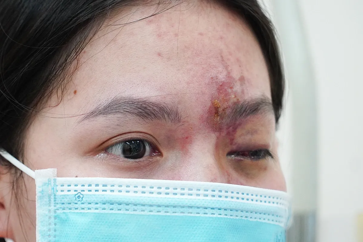 Ti&ecirc;m filler sai c&aacute;ch: Nguy cơ m&ugrave; mắt vĩnh viễn chỉ sau v&agrave;i ph&uacute;t- Ảnh 1.