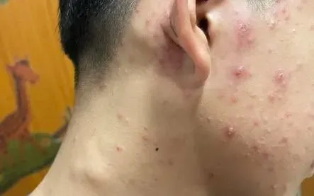 Nghệ An: Gia tăng ca thủy đậu, cảnh báo phụ huynh phát hiện sớm để tránh biến chứng- Ảnh 1. Nghệ An: Gia tăng ca thủy đậu, cảnh báo phụ huynh phát hiện sớm để tránh biến chứng- Ảnh 1.