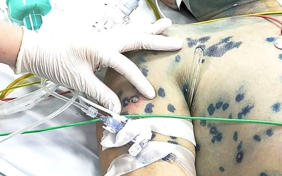 Một bệnh nhân mắc thủy đậu. Ảnh: BVCC