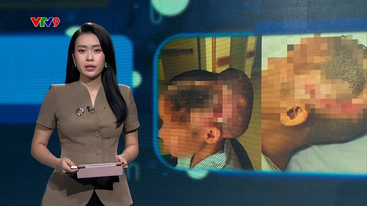 Alo Doctor (03/4/2026): Đột quỵ sau khi cấy mỡ tự thân làm đẹp