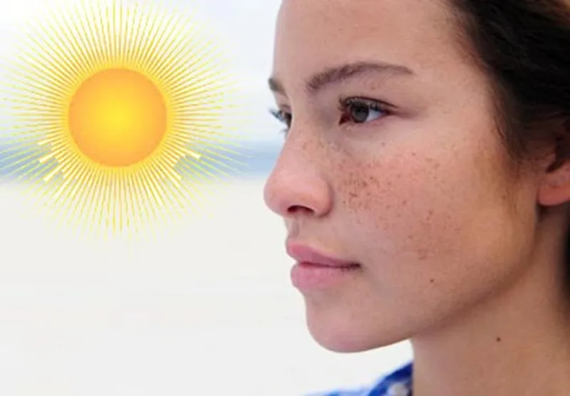 V&igrave; sao da sạm n&aacute;m khi trời nắng?- Ảnh 1.