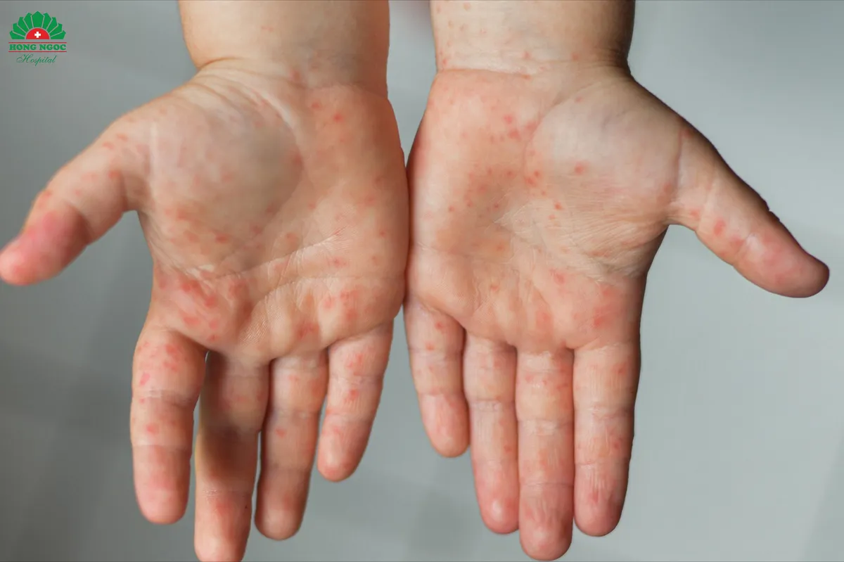 Cảnh b&aacute;o tay ch&acirc;n miệng t&aacute;i nhiễm khi trẻ mới khỏi bệnh - Ảnh 2.