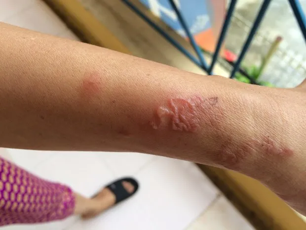 Cảnh b&aacute;o nguy cơ nhiễm giun s&aacute;n từ ch&oacute; m&egrave;o g&acirc;y ngứa k&eacute;o d&agrave;i, nổi mẩn dai dẳng- Ảnh 1.