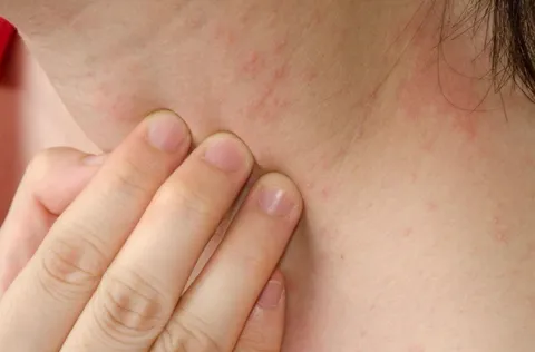 Ngứa k&eacute;o d&agrave;i, mất ngủ c&oacute; thể l&agrave; dấu hiệu suy thận nặng- Ảnh 1.