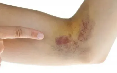 Đi khám sỏi thận, cụ bà ngoài 70 tuổi bất ngờ phát hiện ung thư máu- Ảnh 1. Đi khám sỏi thận, cụ bà ngoài 70 tuổi bất ngờ phát hiện ung thư máu- Ảnh 1.