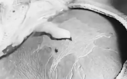 Xử lý khối áp xe cho bệnh nhân. Ảnh: BVCC