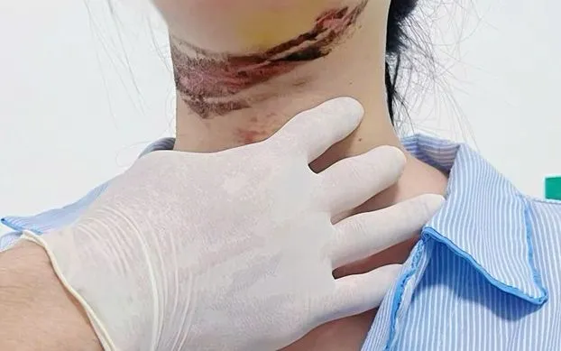 Nữ sinh bị chấn thương ở cổ do vướng dây điện giữa đường
