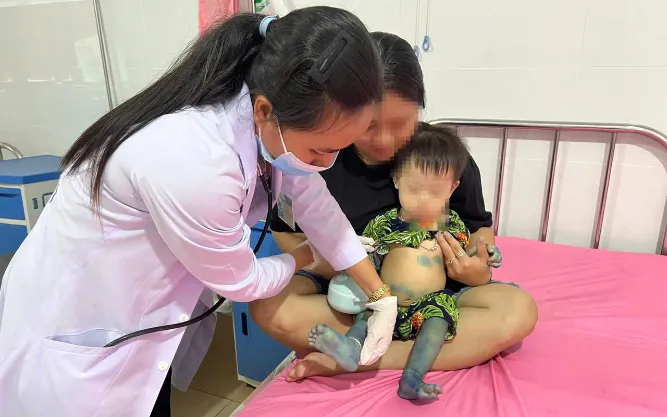 Bác sĩ Trung tâm Y tế khu vực Bình Long khám cho trẻ bị tay chân miệng trước khi xuất viện. Ảnh: CDC Đồng Nai