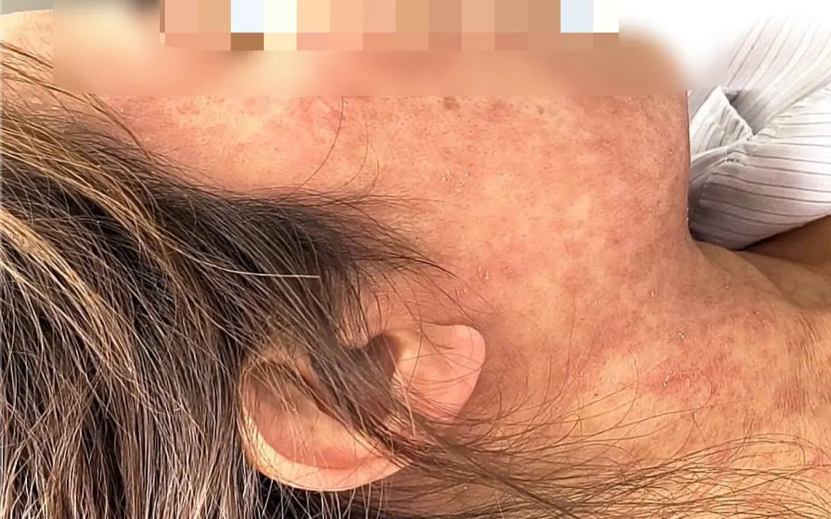 Bệnh nhân mắc sởi biến chứng. Ảnh: BVCC