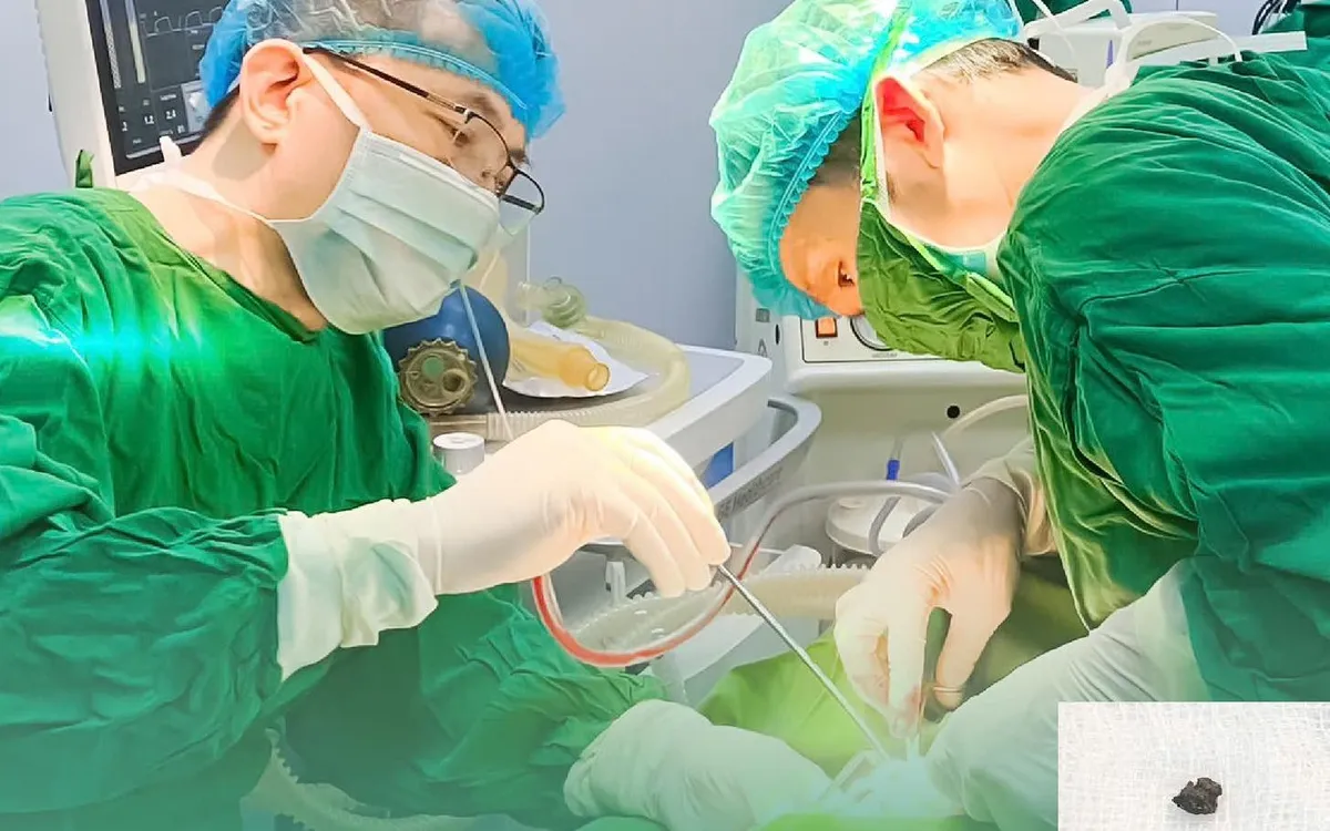 Phẫu thuật lấy dị vật cho bệnh nhân. Ảnh: BVCC
