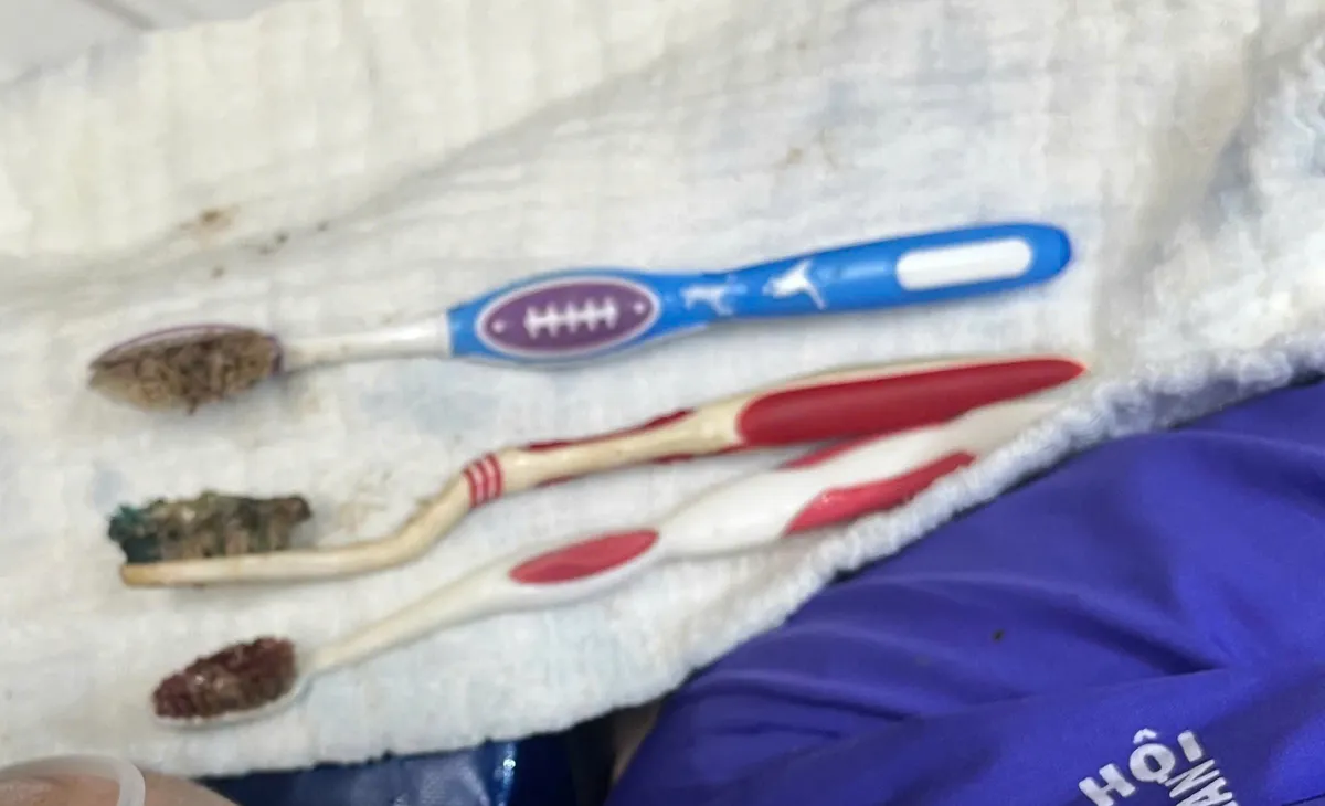 Gắp 3 b&agrave;n chải d&agrave;i gần 20cm khỏi bụng bệnh nh&acirc;n- Ảnh 2.