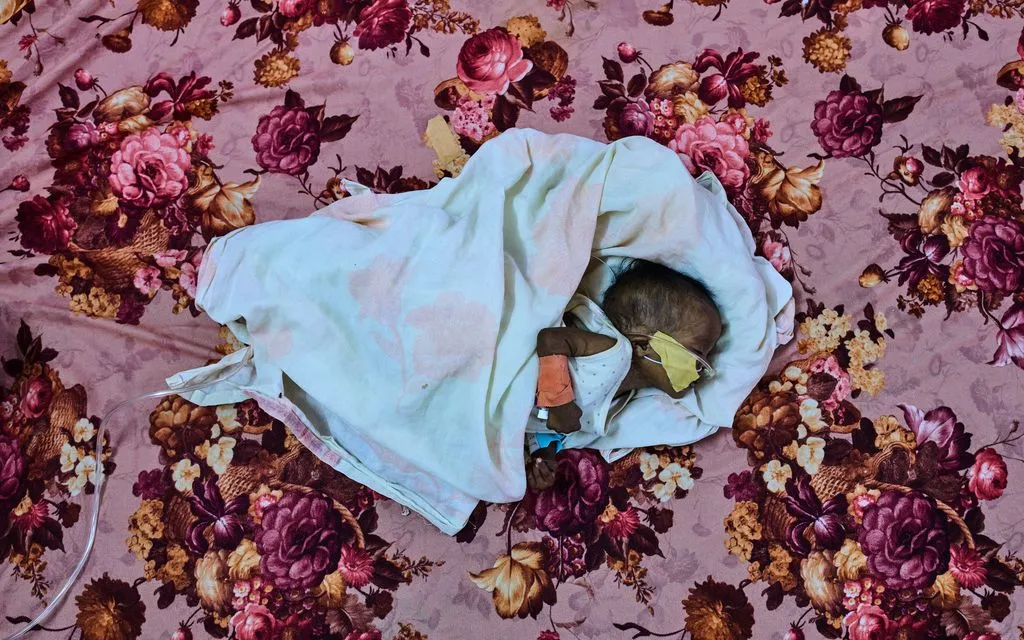 Bệnh nhân Saidal Altaher, 2 tháng tuổi, đang được điều trị suy dinh dưỡng ở Port Sudan, Sudan, ngày 15/4/2026 (Ảnh: AP)