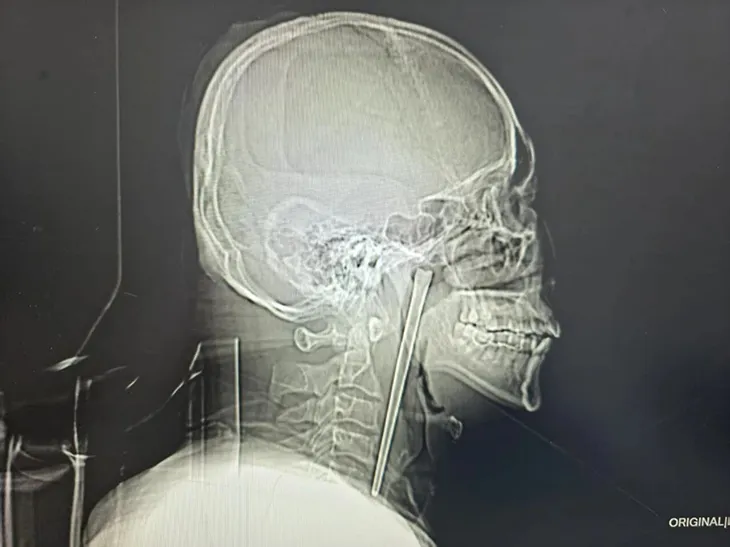 Hy hữu người đ&agrave;n &ocirc;ng Trung Quốc sống 8 năm với chiếc đũa kim loại mắc trong cổ họng- Ảnh 1.