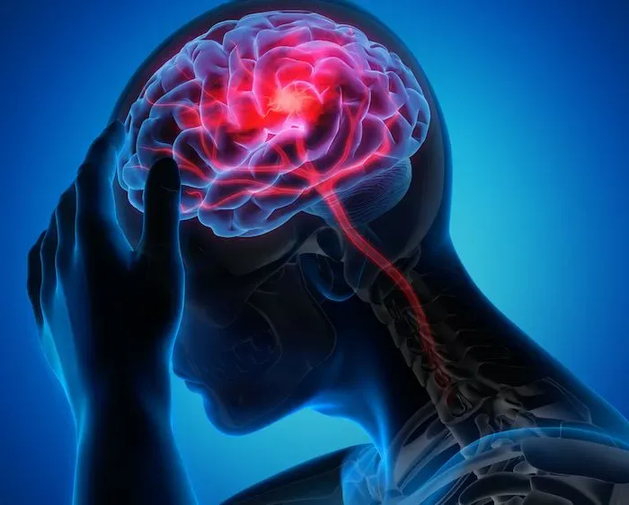 Cảnh b&aacute;o sơ cứu sai c&aacute;ch khiến bệnh nh&acirc;n đột quỵ bỏ lỡ "giờ v&agrave;ng"- Ảnh 1.