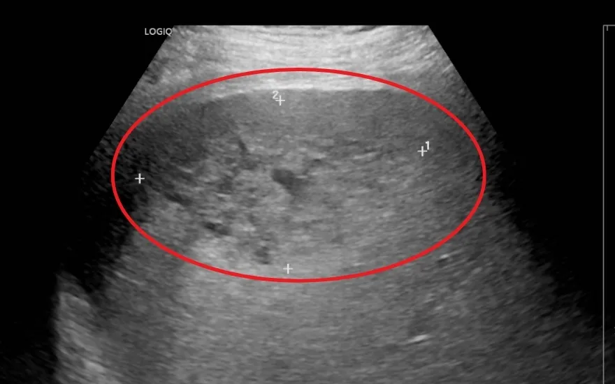 3 lần chọc h&uacute;t &aacute;p xe gan, cứu người đ&agrave;n &ocirc;ng tho&aacute;t cửa tử- Ảnh 1.