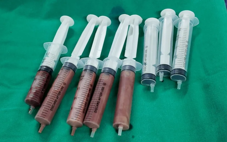 3 lần chọc h&uacute;t &aacute;p xe gan, cứu người đ&agrave;n &ocirc;ng tho&aacute;t cửa tử- Ảnh 3.