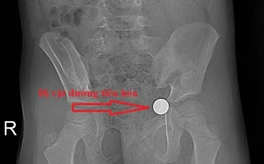 Cảnh b&aacute;o nguy cơ trẻ nuốt dị vật: Một ph&uacute;t lơ l&agrave;, hậu quả kh&oacute; lường- Ảnh 1.