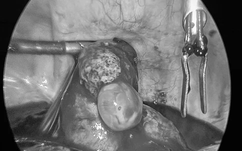 Hình ảnh khối chửa vỡ của bệnh nhân. Ảnh: BVCC