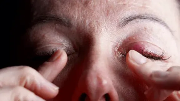 M&iacute; mắt sưng đau cảnh b&aacute;o nhiều bệnh l&yacute;, từ nhiễm tr&ugrave;ng đến rối loạn tuyến gi&aacute;p- Ảnh 1.